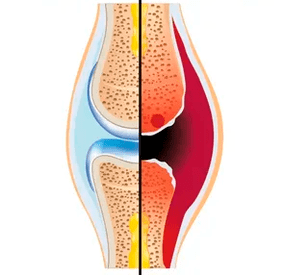 La structure d’une articulation saine et usée appelée tissu cartilagineux et liquide synovial