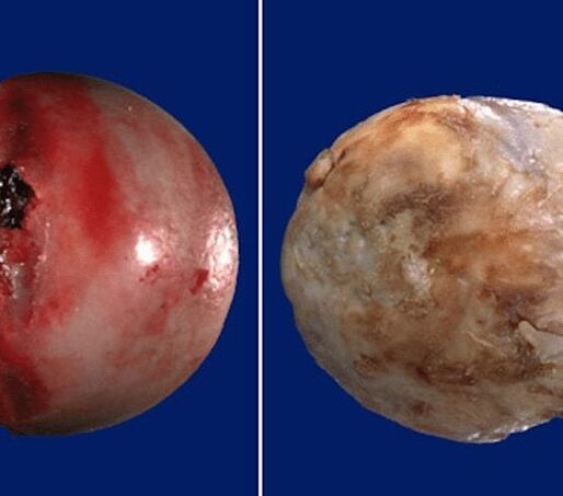 Surface cartilagineuse saine affectée par l'arthrose